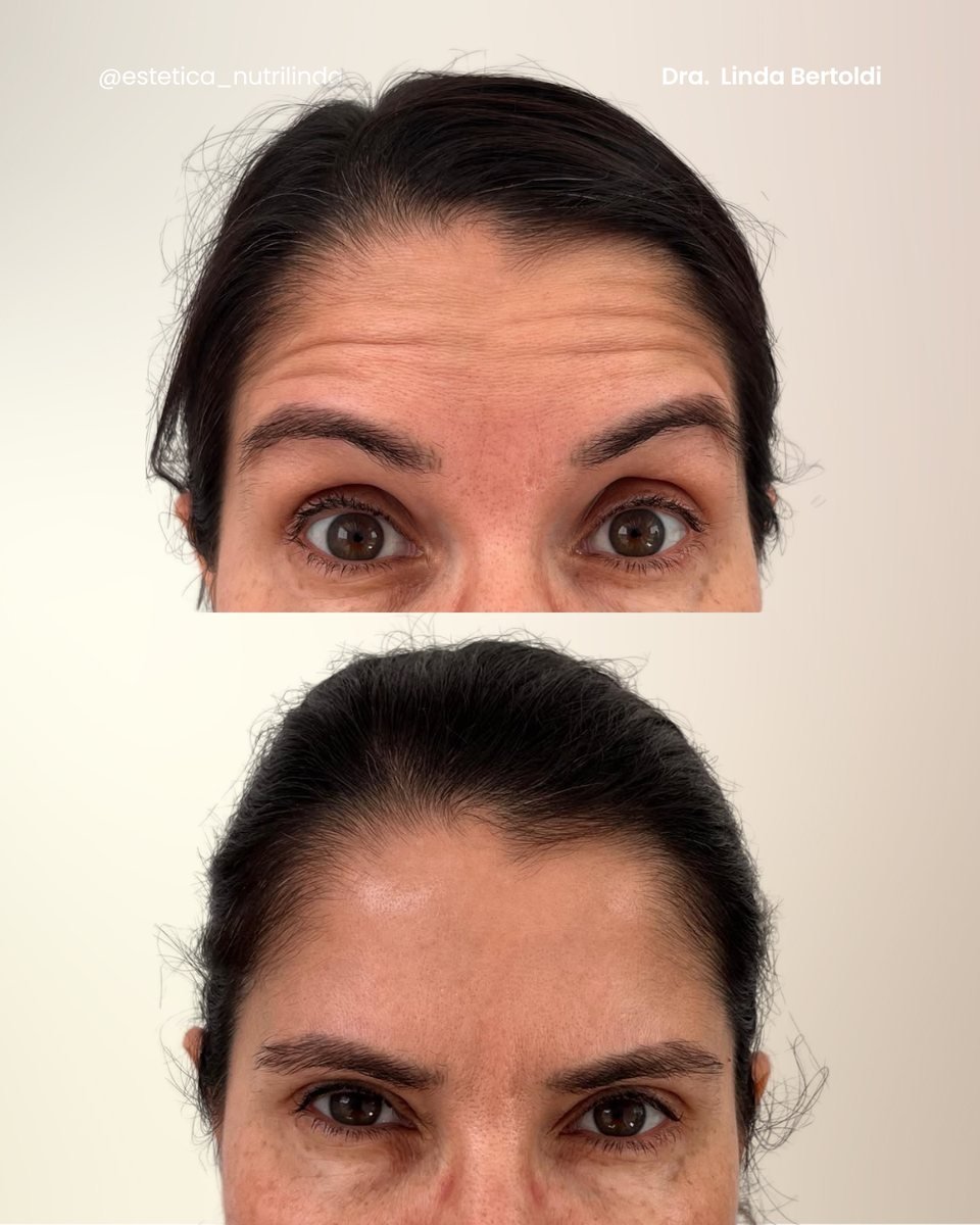 Antes e depois - Club do Botox®