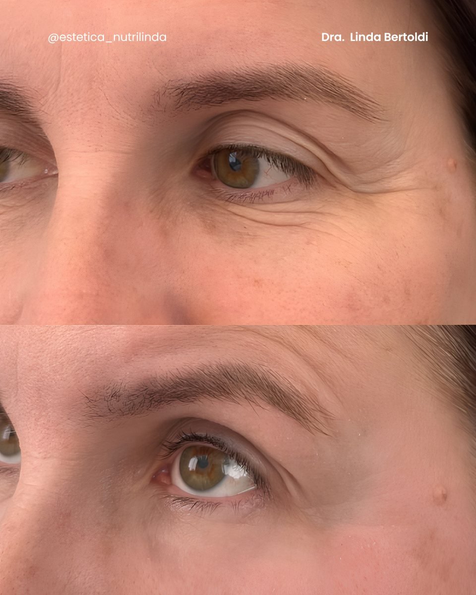 Antes e depois - Club do Botox®
