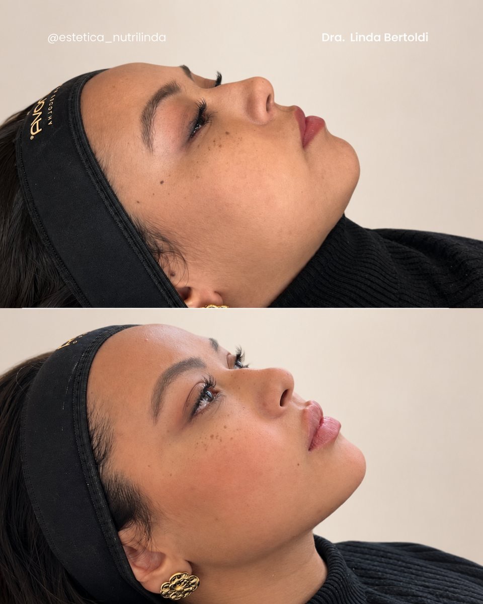 Antes e depois - Harmonização Facial
