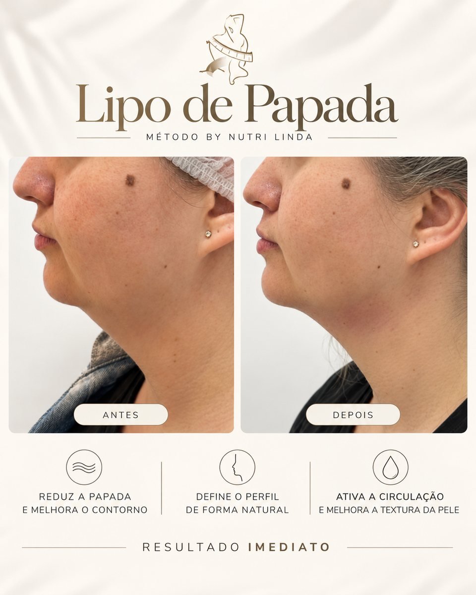 Antes e depois - Lipo de Papada