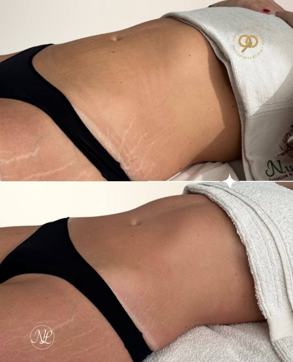 Antes e depois - Lipo na Medida