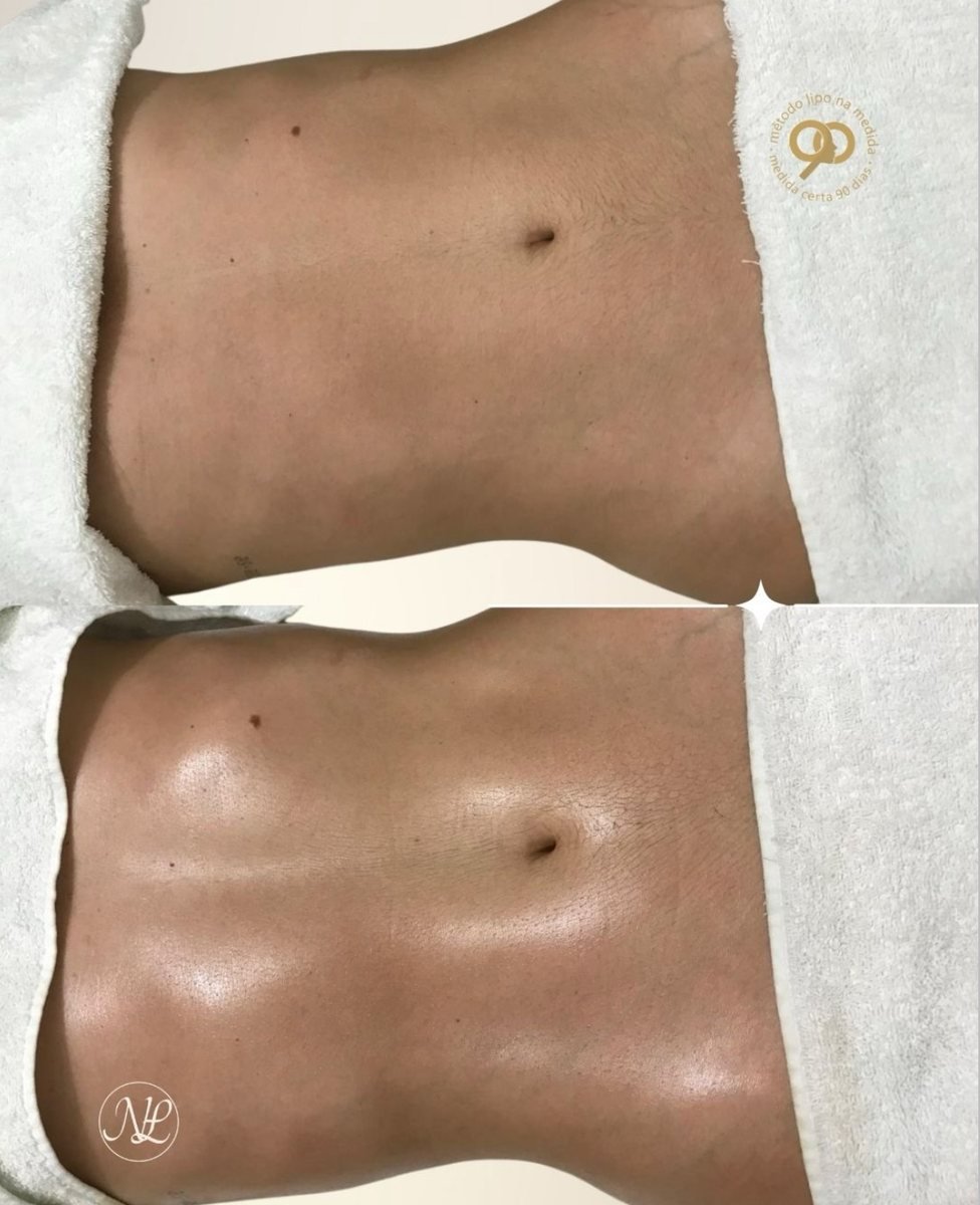 Antes e depois - Lipo na Medida