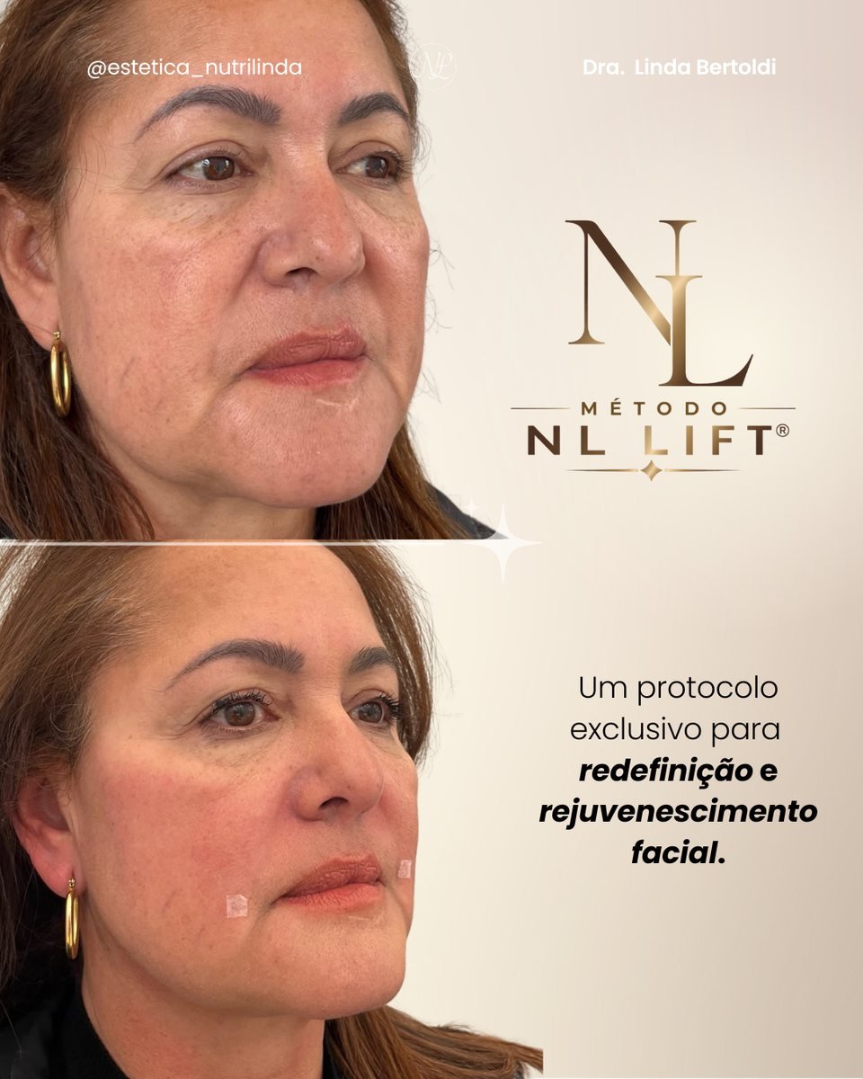 Antes e depois - NL Lift®