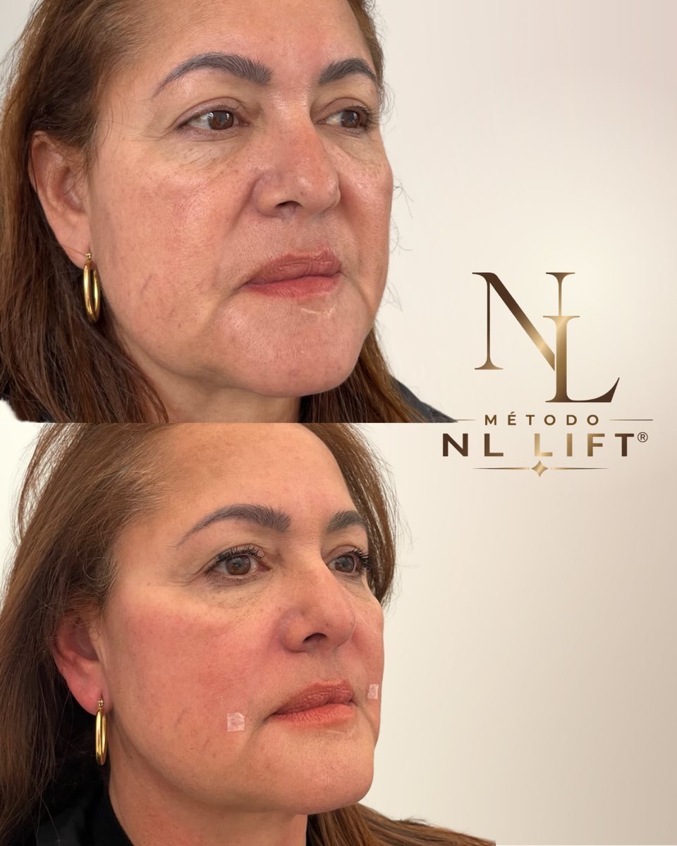 Antes e depois - NL Lift®
