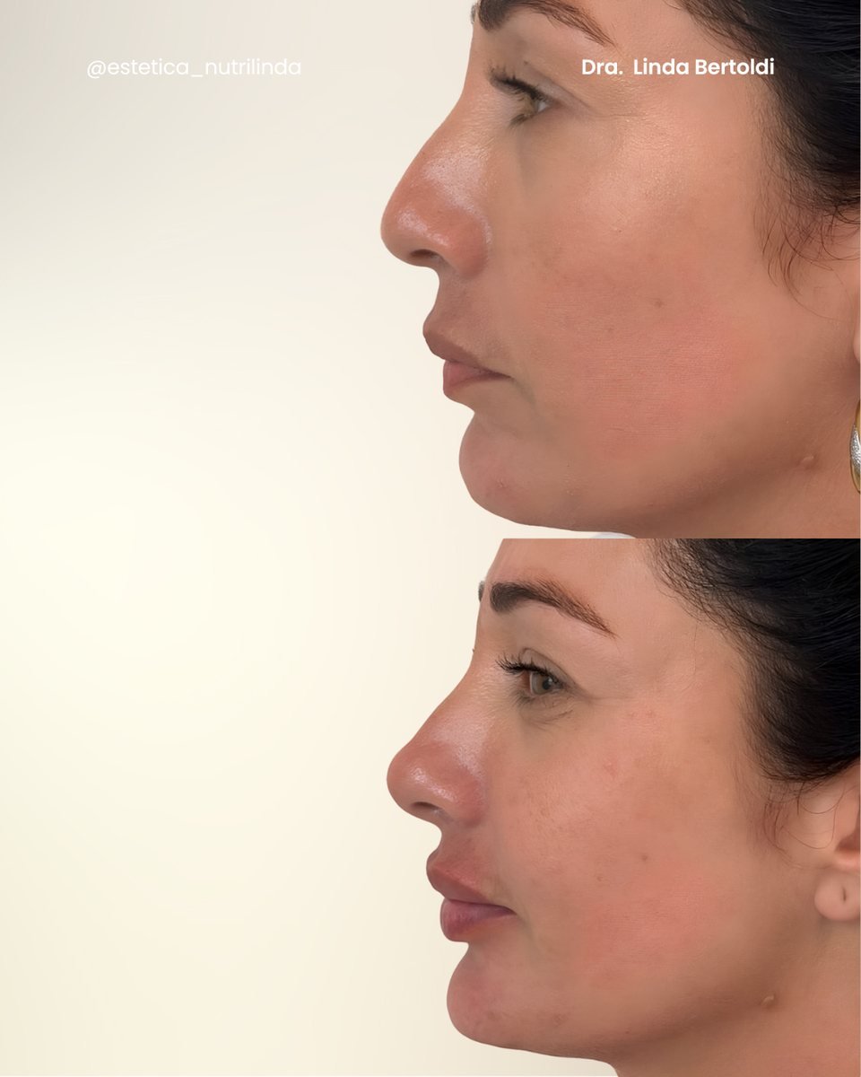 Antes e depois - NL Profile®