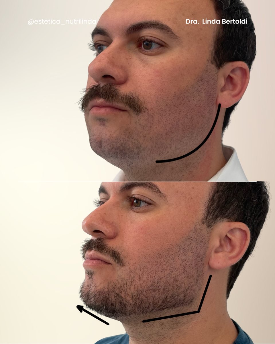 Antes e depois - Preenchimento Mandíbula