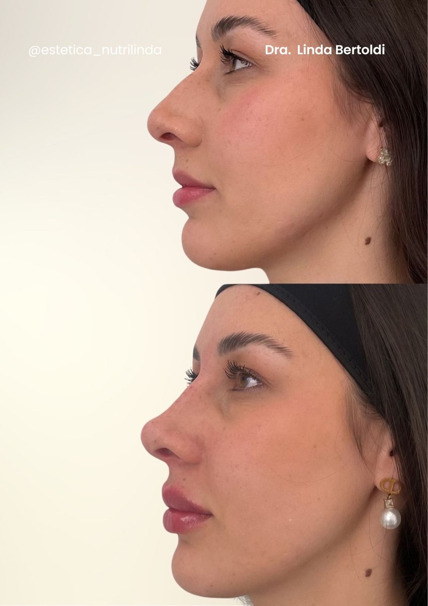Antes e depois - Rinomodelação